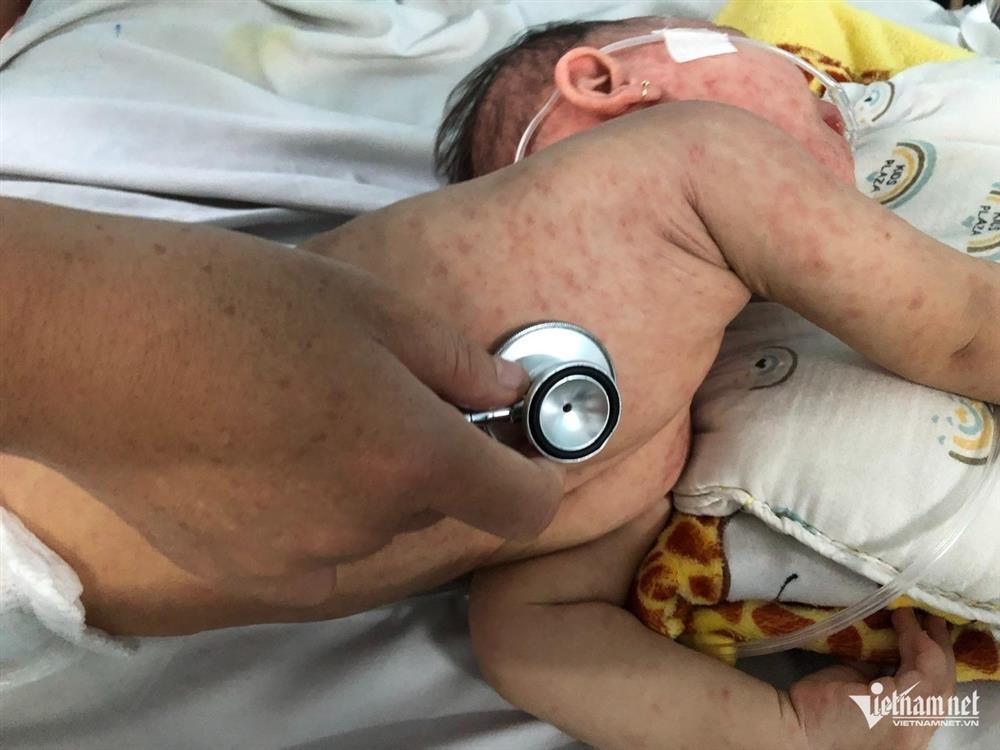 TPHCM công bố dịch sởi